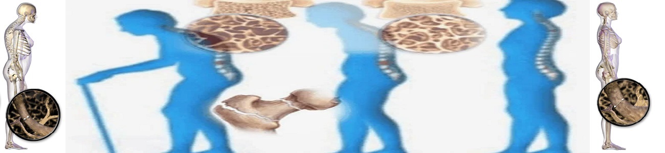 علاجات جديدة لهشاشة العظام